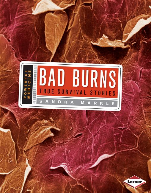 Bad Burns: True Survival Stories